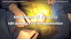 Impianto di protesi idraulica tricomponente