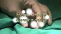 Frenulo corto. Frenulotomia e Frenuloplastica