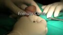 Frenulo corto Frenulotomia e Frenuloplastica. Eiaculazione precoce