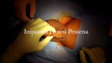 impianto mini invasivo di protesi peniena idraulica tricomponente