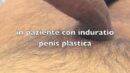 Induratio Penis Plastica e protesi peniena idraulica