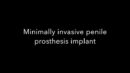 minimally invasive penile prosthesis implant