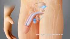 protesi peniene idrauliche