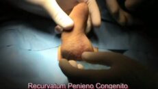 Recurvatum dorsale congenito del pene