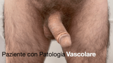 Paziente con patologia vascolare. Attivazione e disattivazione protesi peniena