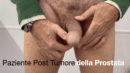 Paziente Post Tumore della Prostata. Attivazione e disattivazione protesi peniena